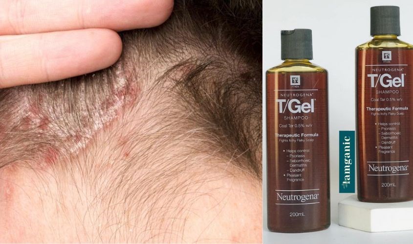 Dầu gội Neutrogena T/Gel Therapeutic ngăn chặn nhiễm khuẩn và nấm cho da