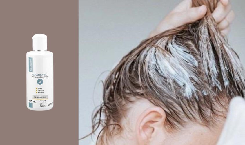 Dầu gội DermoSkin Keratolytic là sản phẩm được bác sĩ da liễu khuyên dùng