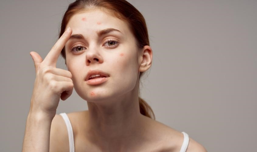 Rau má có chứa chất kháng viêm steroid, hỗ trợ điều trị mụn