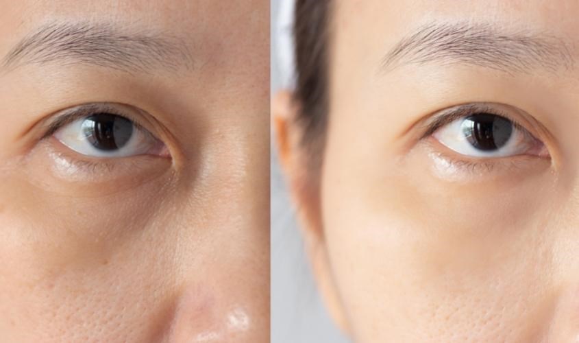 Giúp cải thiện tình trạng da quanh mắt