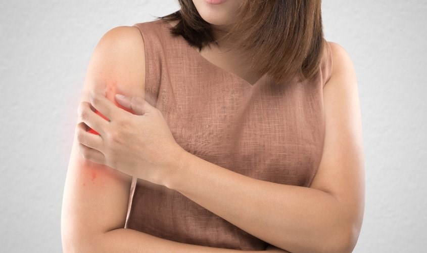 Viêm da cơ địa là bệnh viêm da, ngứa mãn tính