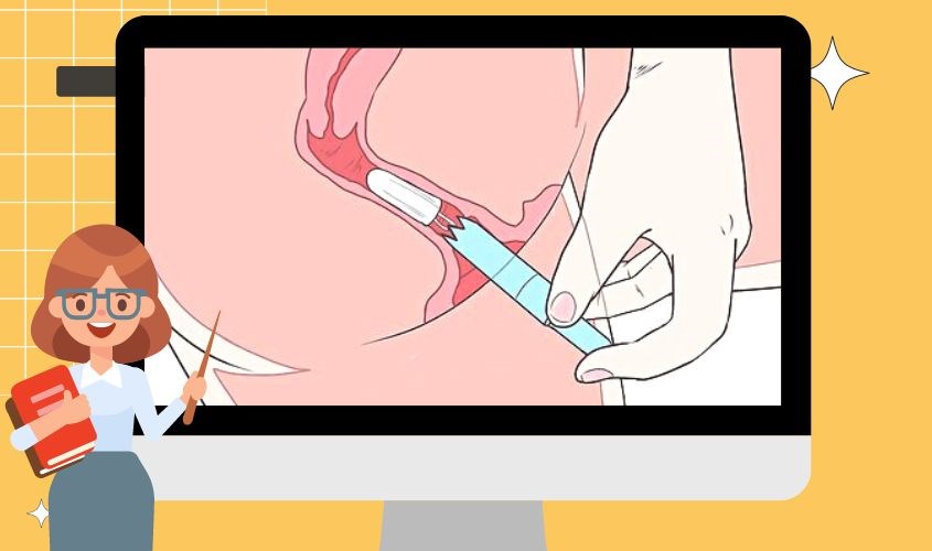 Đẩy pít-tông vào sâu để giải phóng tampon vào đúng vị trí