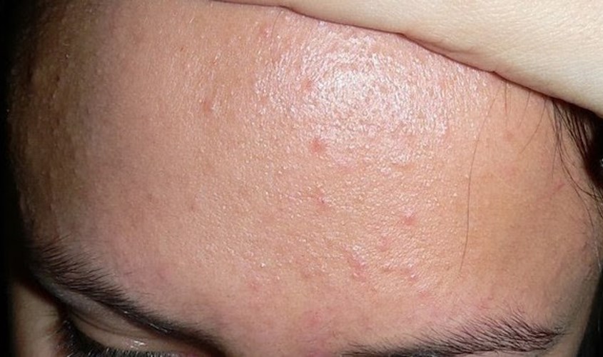 Dấu hiệu nhận biết mụn ẩn