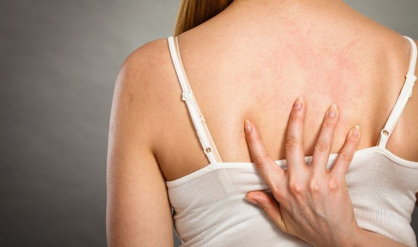 Tác dụng phụ của urea có thể làm ngứa da