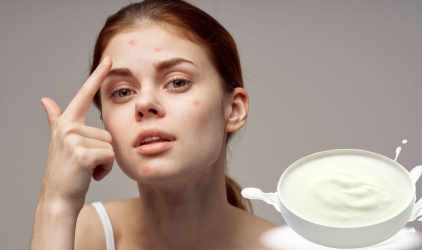 Da mụn không nên tẩy tế bào chết bằng sữa chua