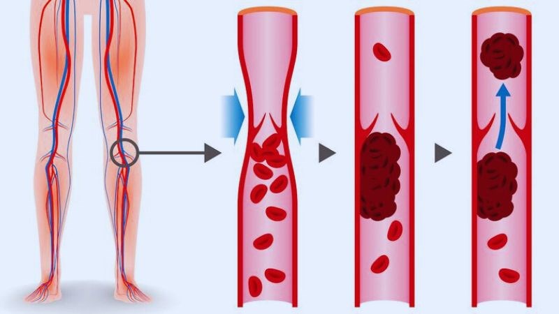 Huyết Khối Tĩnh Mạch Sâu: Nguyên Nhân, Triệu Chứng Và Cách Phòng Ngừa Hiệu Quả