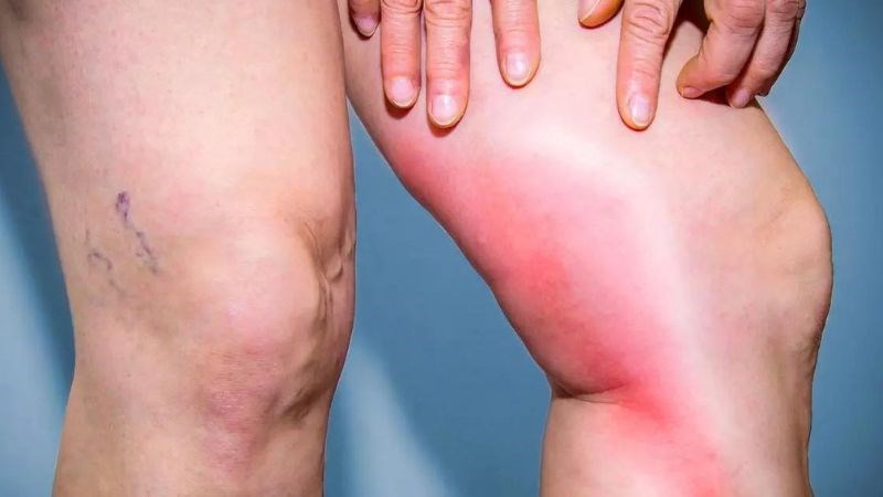 Huyết khối tĩnh mạch sâu gây đau nhức, sưng tấy và biến đổi màu sắc da