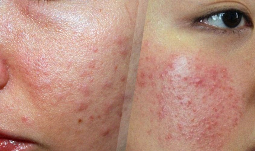 Dị ứng nổi mẩn đỏ, mụn, ngứa ngấy,...