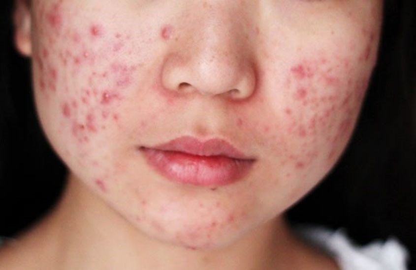 Dùng sản phẩm giả sẽ gây ung thư da