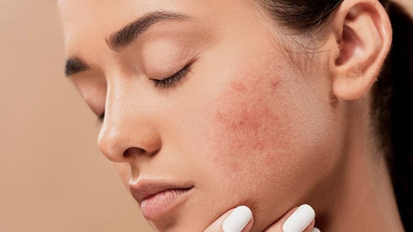 Sản phẩm thích hợp với những bạn có làn da mụn, khô, da dầu