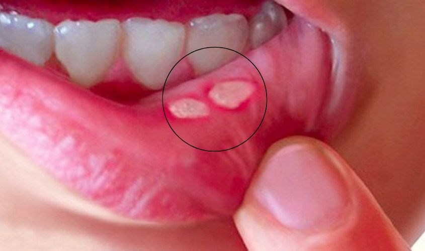 Các vết nhiệt miệng sẽ có hình tròn hoặc hình bầu dục