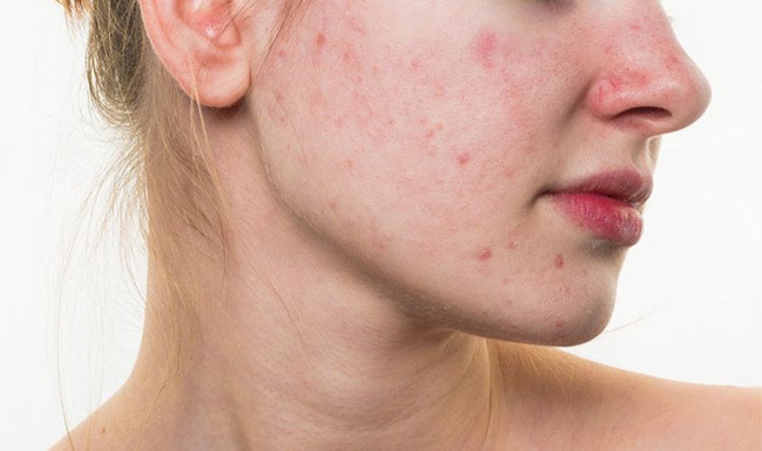 Kem dưỡng trắng da ban đêm Senka có chứa cồn tránh dùng cho chị em bị dị ứng