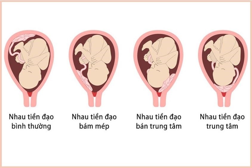Chỉ định mổ lấy thai do nhau tiền đạo