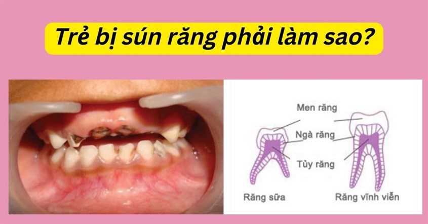 Sún răng có đi nghĩa vụ quân sự? Những điều bạn cần biết