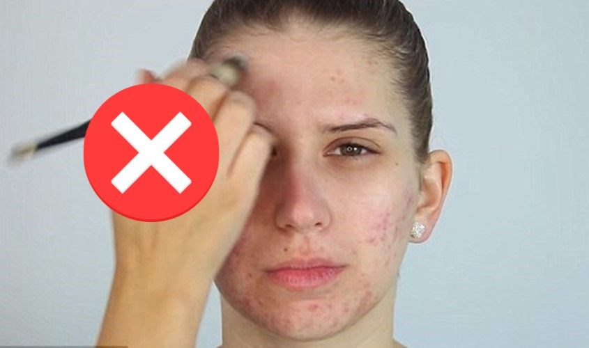 Không trang điểm khi da đang bị mụn sưng viêm hay với những làn da nhạy cảm