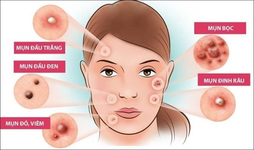 Sợi bã nhờn có ảnh hưởng nghiêm trọng đến tình trạng da