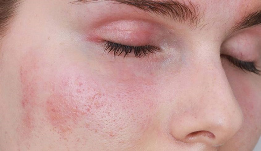 Sữa rửa mặt không tạo bọt dành cho loại da nhạy cảm, dễ tổn thương