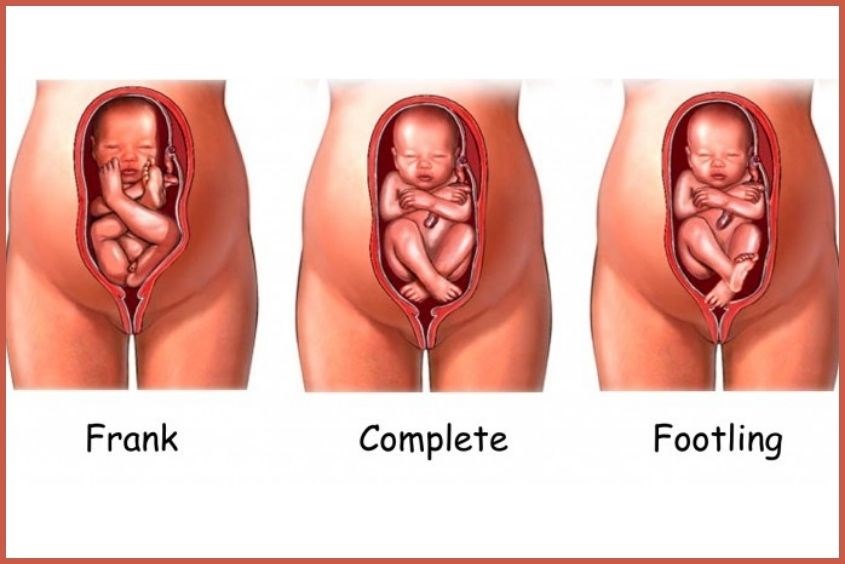 Hình ảnh các dạng ngôi thai mông Ngôi thai là gì