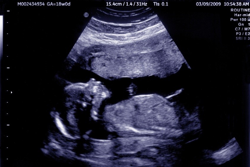 Phương pháp siêu âm để xác định ngôi thai trong bụng mẹ Phương pháp siêu âm để xác định ngôi thai trong bụng mẹ