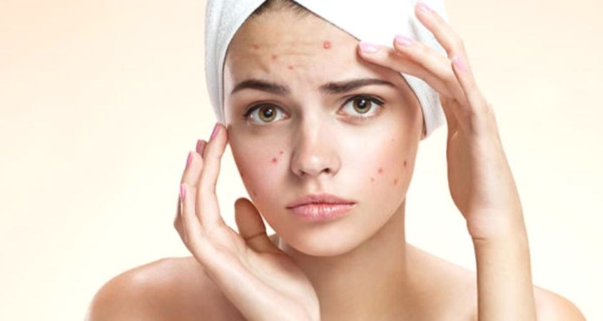 Sản phẩm không có công dụng điều trị mụn