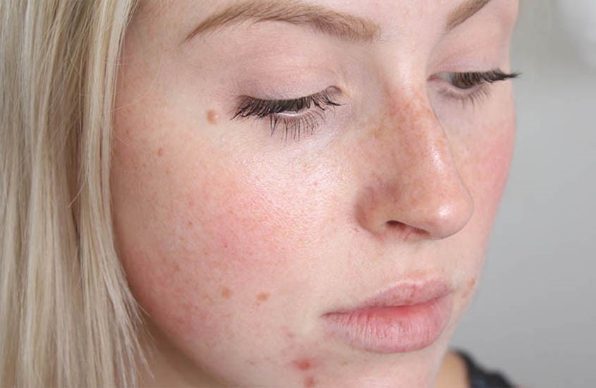 Hãy ngưng sử dụng nếu gặp tình trạng như da bị châm chích, kích ứng, nổi mẩn ngứa