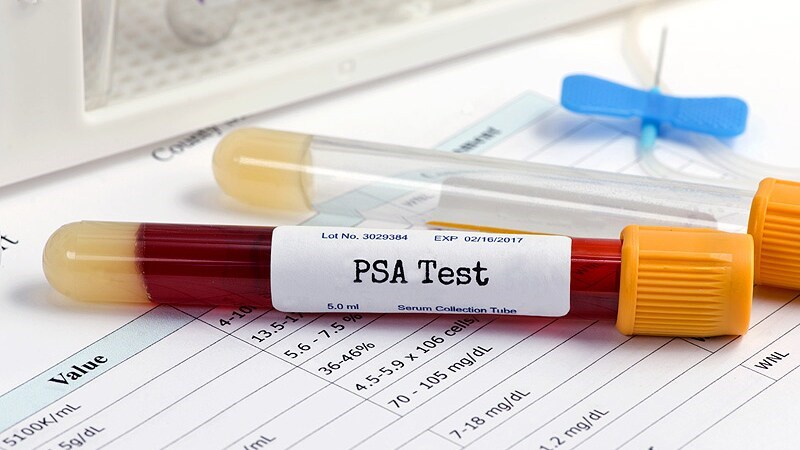 Xét nghiệm kháng nguyên đặc hiệu (PSA) của tuyến tiền liệt giúp kiểm tra tình trạng ung thư tuyến tiền liệt