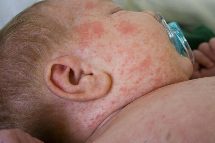 Tắc ruột ở trẻ có nguy hiểm không