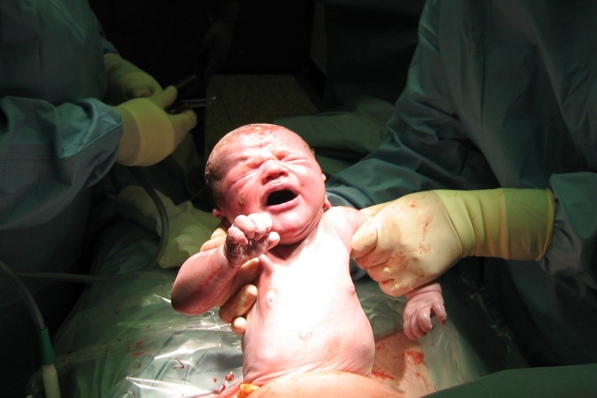 Ảnh mình họa cho quá trình sinh mổ lần 2