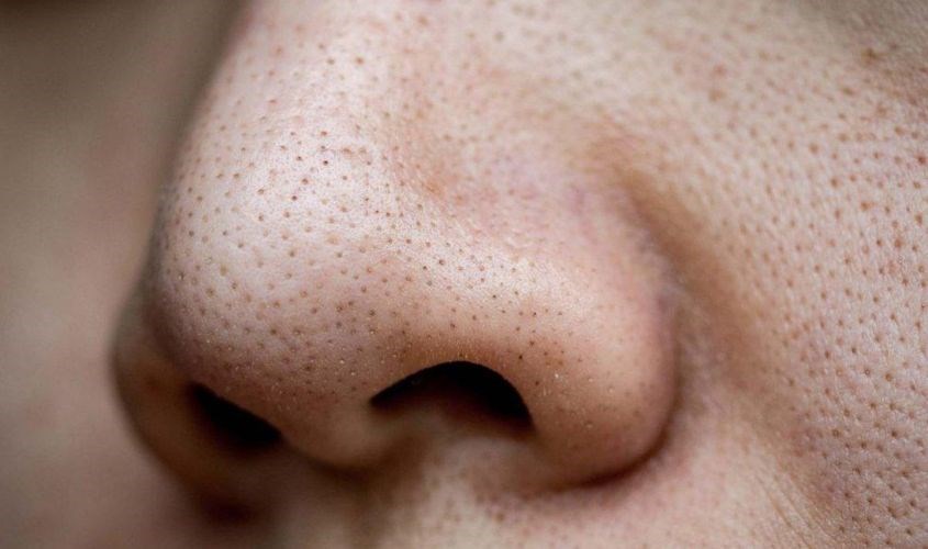 Mụn đầu đen hình thành trên da