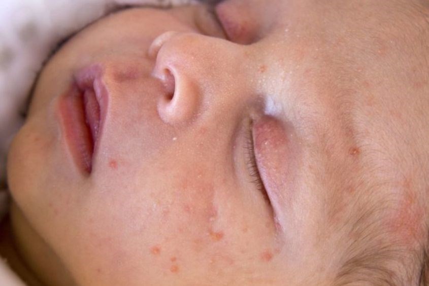 Mụn trứng cá ở trẻ sơ sinh hay còn được gọi là mụn sữa hay nang kê