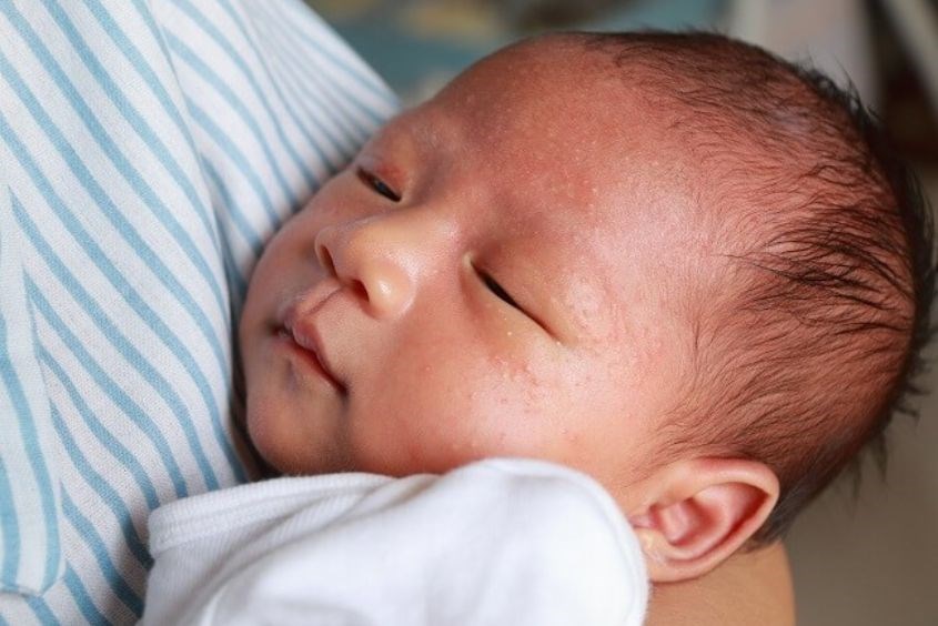 Mụn trứng trứng cá bình thường sau một thời gian sẽ tự biến mất