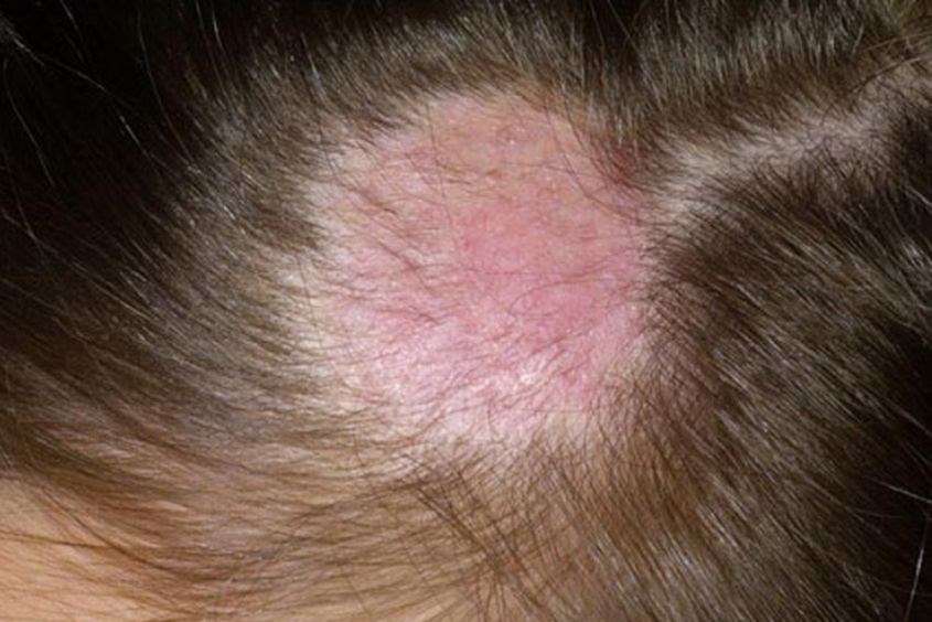 Hình ảnh nấm da đầu ở trẻ sơ sinh