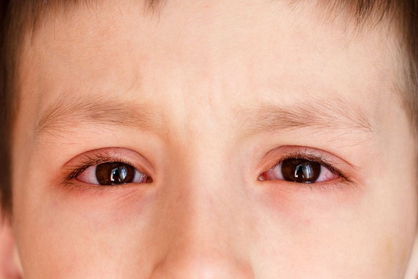 Viêm kết mạc dị ứng Viêm kết mạc dị ứng ở trẻ em