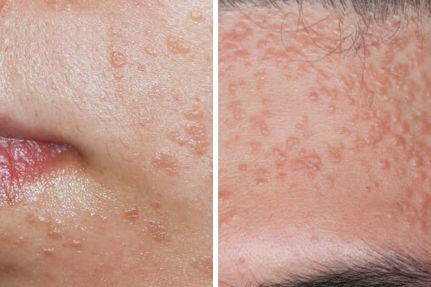 Mụn cóc ở trẻ em dạng phẳng