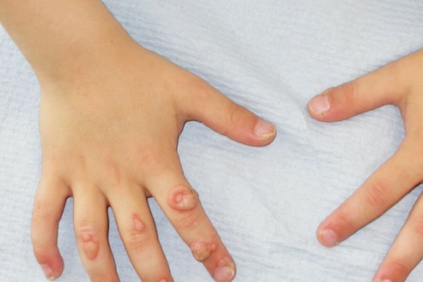 Nguyên nhân gây mụn cóc ở trẻ em