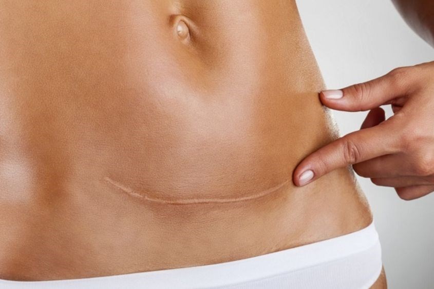 Sau khi sinh mổ không nên ăn rau muống