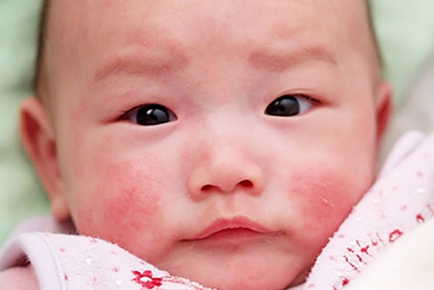 Hồng ban đa dạng ở trẻ nhỏ Biến chứng bệnh chốc lở ở trẻ em