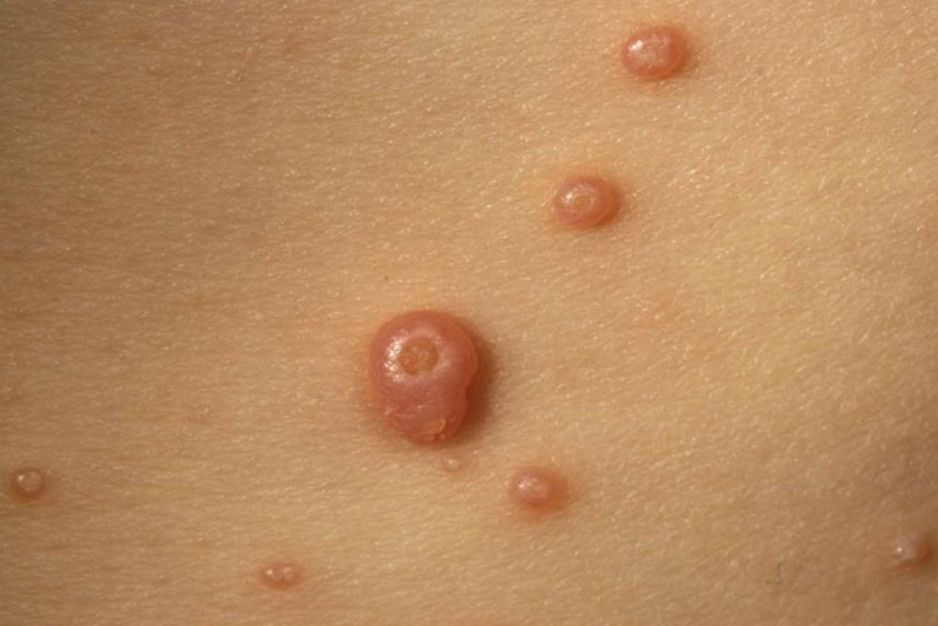 Chốc lở là tình trạng viêm da do sự xâm nhập của tụ cầu hoặc liên cầu khuẩn Bệnh chốc lở ở trẻ em là gì