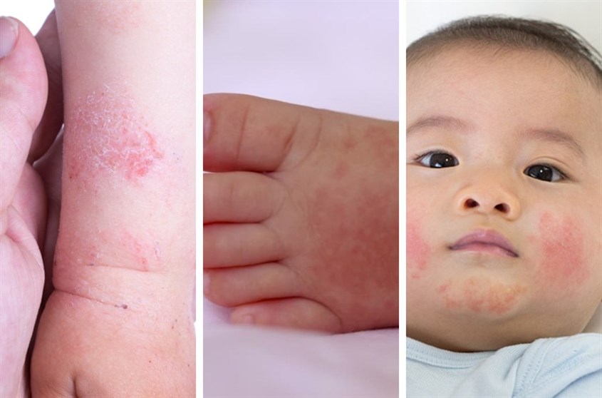 Bé sơ sinh bị chàm sữa