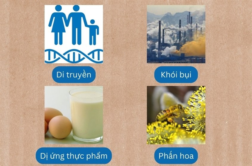 Trẻ sơ sinh bị chàm sữa