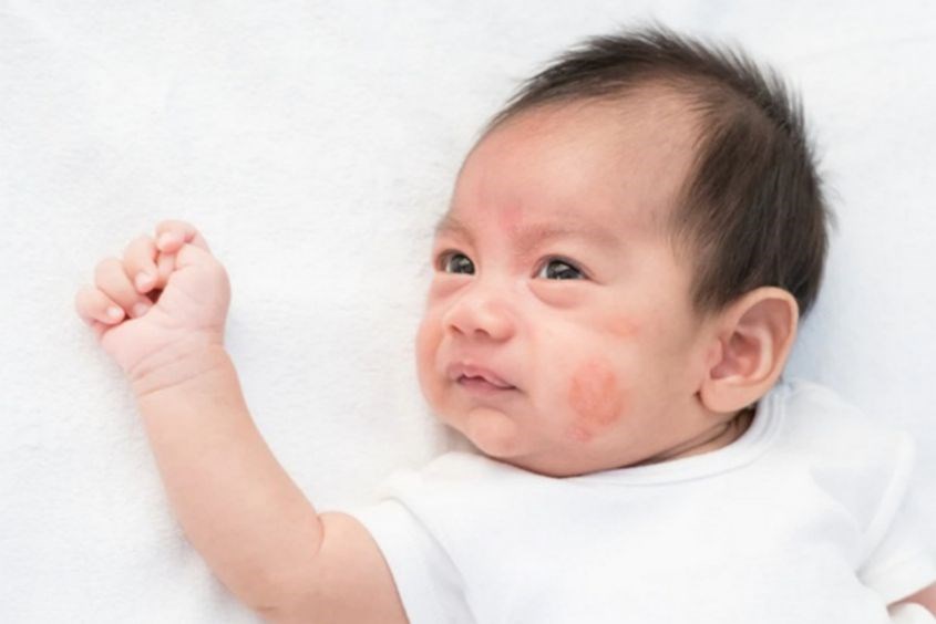 Viêm da cơ địa ở trẻ em chủ yếu do di truyền