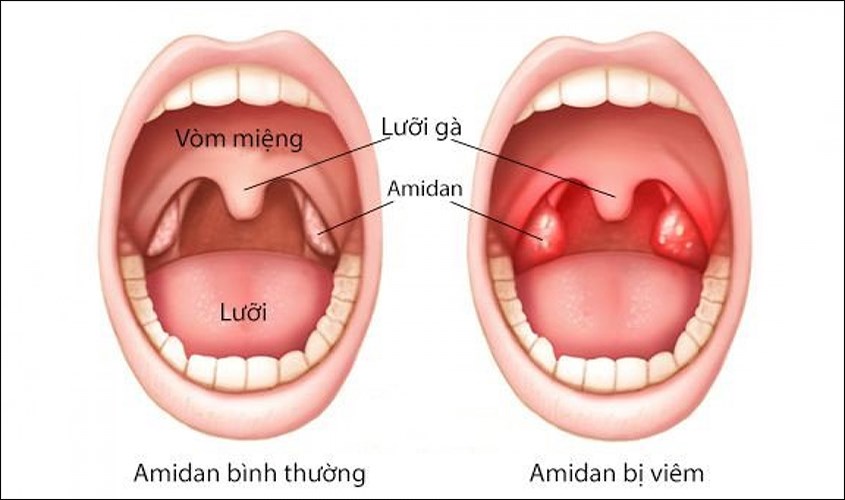 Tình trạng viêm amidan ở trẻ nhỏ Cắt amidan cho trẻ