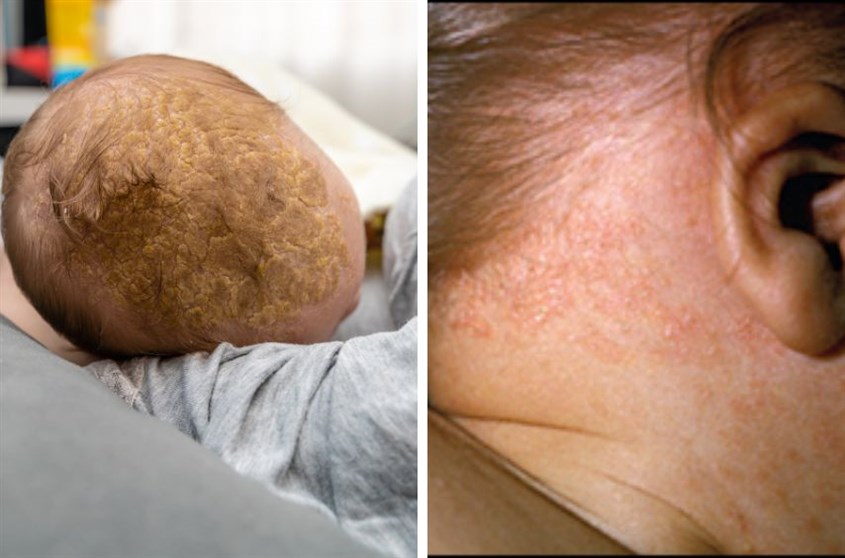 Bé sơ sinh bị viêm da tiết bã 