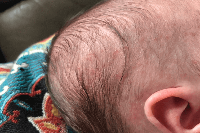 Biến chứng nấm da đầu ở trẻ em ba mẹ nên lưu ý