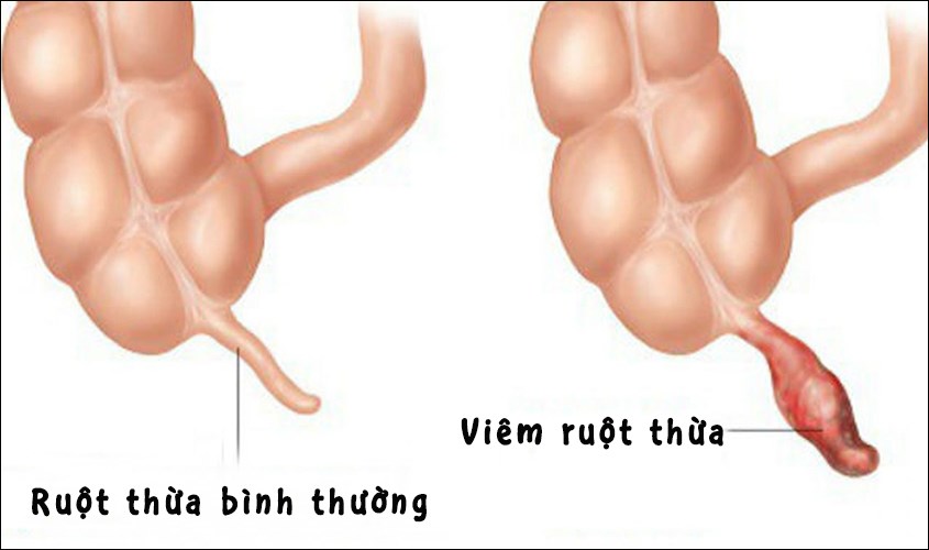 viêm ruột thừa ở trẻ em