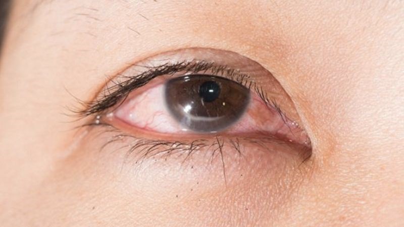 Tắc lệ đạo là nguyên nhân chủ yếu gây ra chảy nước mắt