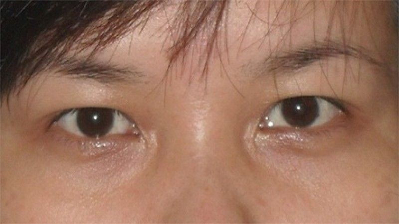 Mi mắt rũ xuống và tật lộn mi khiến mắt chúng ta chảy nước mắt nhiều hơn