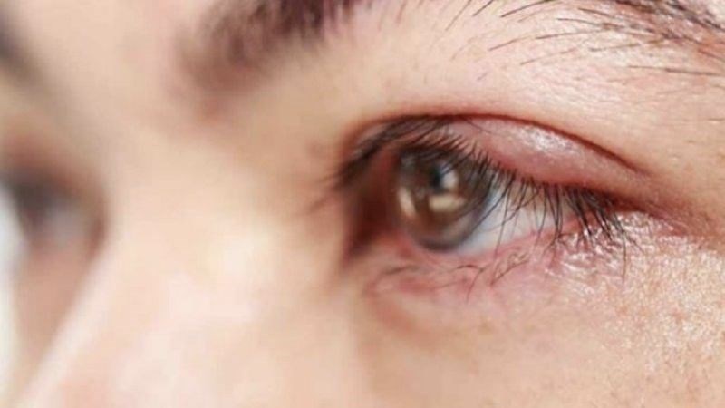 Vi khuẩn là tác nhân chính gây nhiễm trùng mắt dẫn đến chảy nước mắt sống