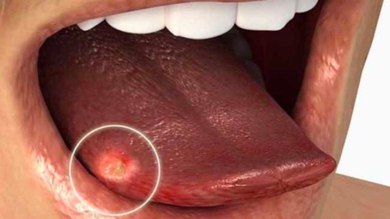 Địa y lưỡi có thể biểu hiện dưới dạng các các mô sưng đỏ, viền mắt, hoặc vết loét hở