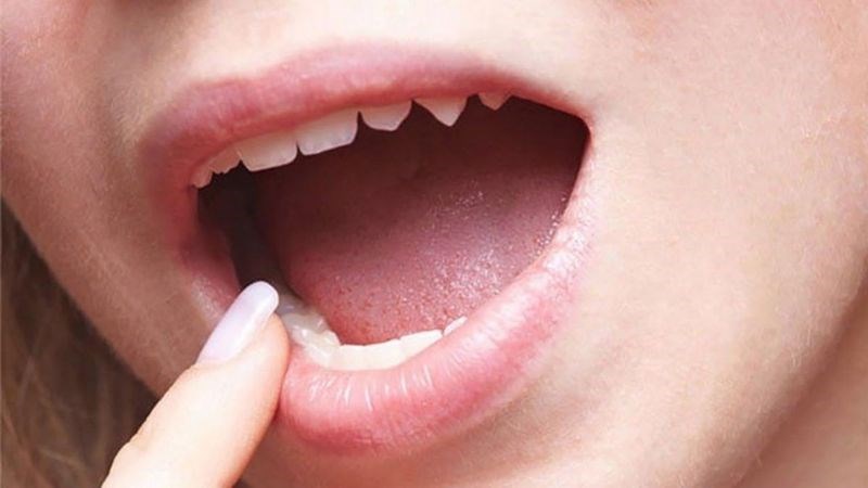 Bệnh phù thũng ở miệng sẽ dẫn đến tình trạng địa y miệng